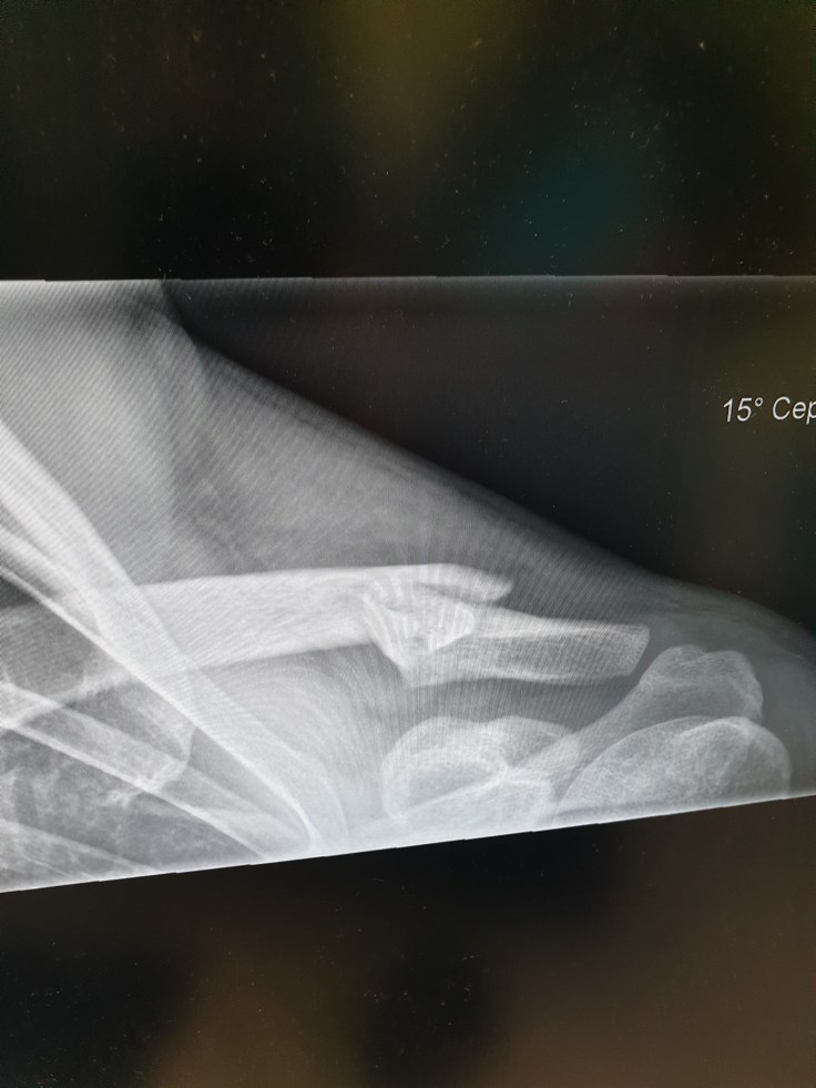 X-Ray of Broken Left Collarbone